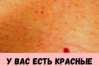 У вас есть красные точки на теле? Знайте - это симптом Тужилина! 9 imbirnaya-voda-glavnyy-vrag-zhira-na-bedrah-i-zhivote_-kak-ee-pravilno-prigotovit-10