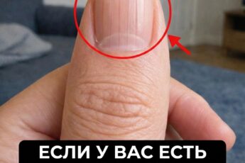 Если на ваших ногтях появились бороздки, это может быть сигналом о том, что в организме…